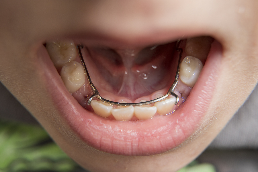 Understanding Space Maintainers: Essential for Children’s Dental Health